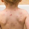 5 آلاف إصابة أسبوعيًا بجدري الماء في غزة وتحذيرات من تفشيه